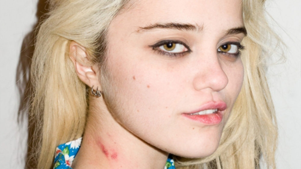 how to get rid of hickeys overnight